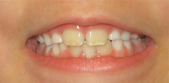 Tẩy trắng răng là cách làm thay đổi màu sắc của răng, giúp răng trắng sáng hơn so với màu răng ban đầu. Đây là phương pháp được rất nhiều khách hàng lựa chọn để cải thiện tình trạng răng bị nhiễm màu khiến, bạn thiếu tự tin trong giao tiếp. Tuy nhiên, tẩy trắng răng có làm mòn men răng không? Có gây hại gì không? Trước khi tẩy trắng răng, bạn nên tìm hiểu kỹ phương pháp này nhé! 1. Tại sao răng bạn bị nhiễm màu? Răng bị nhiễm màu do nhiều nguyên nhân gây ra, Có 2 trường hợp nhiễm màu răng là: nhiễm màu trên bề mặt và nhiễm màu sâu bên trong cấu trúc răng. Trường hợp răng bị nhiễm màu trên bề mặt là do: Sử dụng những thực phẩm, đồ uống có màu như: sô-cô-la, trà, cà phê, nước ngọt… làm mòn men răng, gây ảnh hưởng vẻ đẹp tự nhiên của cả hàm răng. Nhựa thuốc lá cũng làm răng bị xỉn màu. Vì vậy, người hút thuốc lá lâu năm sẽ gặp phải tình trạng răng ố vàng, mất thẩm mỹ. Đánh răng và sử dụng chỉ nha khoa chưa đúng cách, cũng sẽ tạo điều kiện cho thức ăn thừa và vi khuẩn bám vào răng, khiến màu răng sậm hơn. Những loại nước súc miệng chứa Hexetidine cũng sẽ làm răng nhiễm màu, nếu sử dụng trong một thời gian dài. Trường hợp răng bị nhiễm màu bên trong cấu trúc răng Theo thời gian, lớp men răng bên ngoài sẽ bị mòn dần. Khi sử dụng nhiều loại thực phẩm, đồ uống có sắc tố gây nhiễm màu, cũng sẽ khiến tình trạng răng bị nhiễm màu trở nên nặng hơn. Răng bị nhiễm màu cũng có thể do di truyền, cấu tạo men răng dày hay mỏng. Nếu lớp men này càng mỏng thì càng lộ rõ ngà răng vàng bên trong. Nếu các thành viên trong gia đình có răng bị xỉn màu, bạn cũng có nguy cơ bị vàng răng rất cao. Khi sử dụng kháng sinh Tetracycline thì các hoạt chất trong kháng sinh sẽ khuếch tán vào mô canxi, làm cho muối của các nguyên tố màu thấm vào khiến răng bị nhiễm màu. Nếu phụ nữ mang thai hoặc trẻ em trước 7 – 8 tuổi uống loại thuốc này thì răng sẽ bị đổi màu trên toàn bộ hàm hoặc chỉ ở một vùng nào đó với 4 mức độ: vàng, nâu, xám, tím. Sử dụng nguồn nước có nồng độ Fluor cao hoặc dùng kem đánh răng có quá nhiều fluor hoặc bổ sung florua bằng đường uống cũng là nguy cơ đổi màu bên trong cấu trúc răng. Khi răng bị nhiễm màu và muốn cải thiện màu răng, rất nhiều khách hàng đã tìm đến phương pháp tẩy trắng răng. Để giúp khách hàng có được đầy đủ kiến thức và đỡ tốn thời gian tìm kiếm, chúng tôi đã tổng hợp 1 bài viết chi tiết về RĂNG VÀNG Ố, bạn xem nhé!!! 2. Tẩy trắng răng là gì? Là phương pháp dùng các chất oxy hóa (Hydrogen Peroxide) cho thấm qua lớp men. Hydrogen Peroxide khi kết hợp với năng lượng ánh sáng sẽ tạo ra phản ứng oxy hóa để cắt đứt các chuỗi phân tử màu tối trong ngà răng, giúp răng trắng sáng hơn so với màu răng ban đầu mà sẽ không làm tổn hại bề mặt răng hoặc bất kỳ yếu tố nào trong răng. 3. Tẩy trắng răng có tốt không? Hiện nay, có nhiều cách làm thay đổi màu sắc răng, và tẩy trắng răng đang là phương pháp được áp dụng nhiều tại Việt Nam và nhiều nước trên thế giới. Phương pháp này được nghiên cứu là an toàn cho sức khỏe răng miệng, không làm tổn hại men răng, không thay đổi cấu trúc răng nếu được thực hiện đúng cách. Để quy trình tẩy răng đảm bảo an toàn và đạt kết quả tốt nhất, bạn nên tìm đến nha khoa uy tín, để được sử dụng thuốc tẩy trắng chính hãng, rõ ràng về nguồn gốc, có hệ thống đèn hỗ trợ tẩy trắng răng hiện đại. Kết quả tẩy trắng răng ở mỗi người sẽ khác nhau, phụ thuộc vào nguyên nhân và tình trạng nhiễm màu ban đầu của răng. Sau khi tẩy răng, độ trắng có thể giảm dần theo thời gian nhưng màu răng vẫn trắng hơn so với ban đầu. 4. Trường hợp nào không nên tẩy trắng răng? Hầu hết ai cũng có thể tẩy trắng răng, trừ những trường hợp sau: Phụ nữ đang mang thai và cho con bú, vì những hoạt chất trong thuốc tẩy răng sẽ gây ảnh hưởng đến sức khỏe sau này của trẻ nhỏ. Trẻ em chưa đủ 16 tuổi cũng không nên tẩy răng vì thuốc tẩy trắng có thể gây kích thích tủy, khiến răng trở nên nhạy cảm hơn. Người mắc bệnh viêm nha chu, răng sâu, hở cổ chân răng…và những người có dấu hiệu dị ứng với thuốc tẩy trắng răng. 5. Các phương pháp tẩy trắng răng hiện nay Bạn có thể tham khảo 2 phương pháp tẩy trắng răng phổ biến sau: Đeo máng tẩy trắng răng tại nhà: Bác sĩ sẽ lấy dấu răng và làm máng tẩy đúng với kích thước răng của mỗi người. Máng tẩy trắng được làm bằng nhựa plastic trong suốt, an toàn và không gây tổn thương đến nướu, có tác dụng giữ thuốc tẩy, ngăn nước bọt tràn vào, gây ảnh hưởng đến quá trình tẩy trắng răng Phương pháp này là giúp bạn chủ động thời gian vì được thực hiện ngay tại nhà với chi phí hợp lý. Nhưng nó lại không đạt hiệu quả cao với những trường hợp răng bị nhiễm màu quá nặng. Tẩy trắng răng tại phòng khám nha Liệu trình làm trắng răng tại phòng nha bao gồm 3 bước: cạo vôi, đánh bóng và tẩy trắng răng. Bác sĩ sẽ kết hợp thuốc có nồng độ tẩy trắng từ 35 – 37% và chùm ánh sáng cường độ mạnh để kích hoạt thuốc ngấm sâu hơn vào bên trong. Trước khi sử dụng thuốc tẩy trắng, bạn sẽ được đeo dụng cụ bảo vệ môi, nướu, khoang miệng và bôi thêm thuốc chống ê buốt. Ưu điểm của phương pháp này là được thực hiện nhanh chóng, có tác dụng cả với những trường hợp nhiễm màu nặng, hàm trên và hàm dưới được tẩy trắng cùng một lúc nên cả hai hàm răng sẽ được trắng đều tự nhiên. Hiện nay, tình trạng tẩy trắng răng đang được thực hiện tràn lan tại nhiều cơ sở nha khoa chưa có đủ trang thiết bị, hoặc một số khách hàng tự mua thuốc về tẩy trắng răng tại nhà, dẫn đến hậu quả làm bỏng nướu răng, viêm tủy… Vì vậy, nếu đang có nhu cầu tẩy răng, bạn hãy tìm đến các trung tâm nha khoa uy tín, tin cậy để mang lại hiệu quả tối ưu và an toàn nhất. Nhiều khách hàng đang có nhu cầu tìm hiểu về tẩy trắng răng, có thể tham khảo thêm bài viết >>> Thắc mắc tẩy trắng răng có hại không?