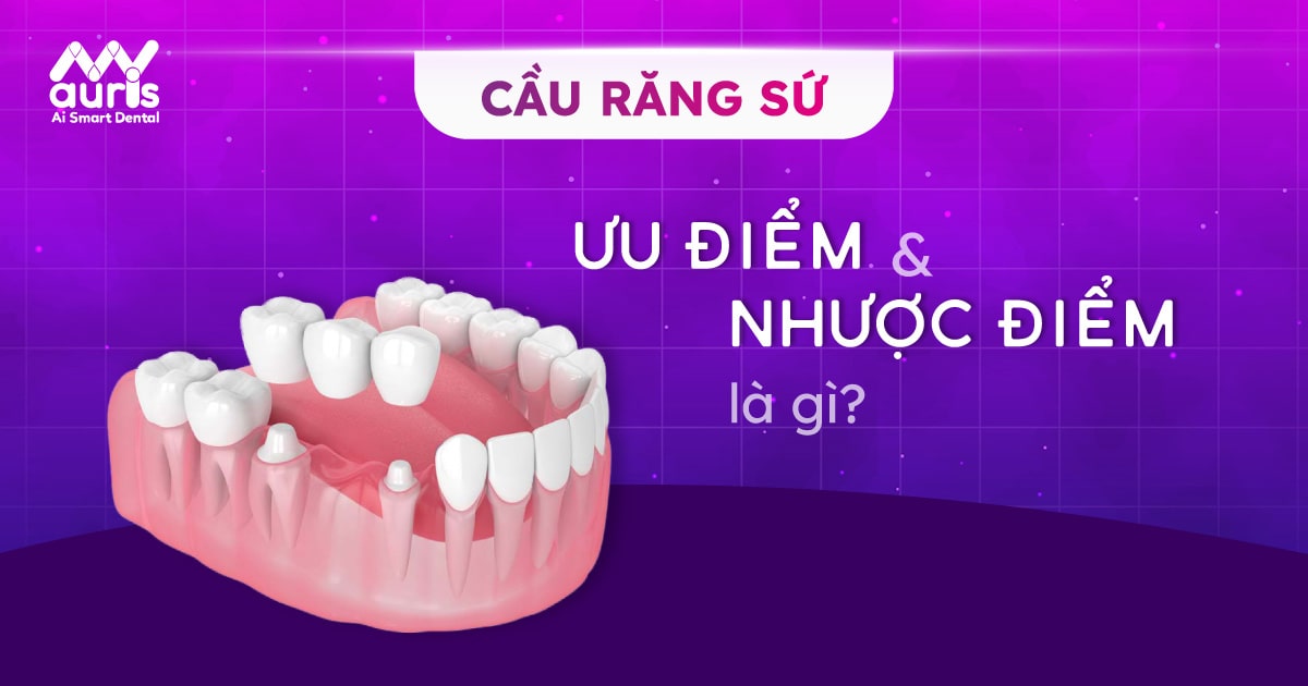 cầu răng sứ