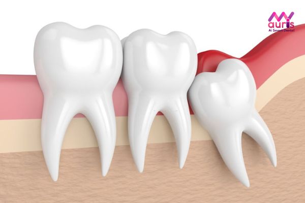 Răng khôn là răng gì?