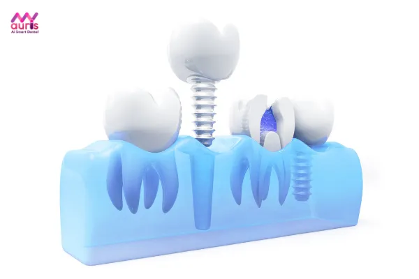 khi bị mất răng nên cấy bao nhiêu trụ implant 