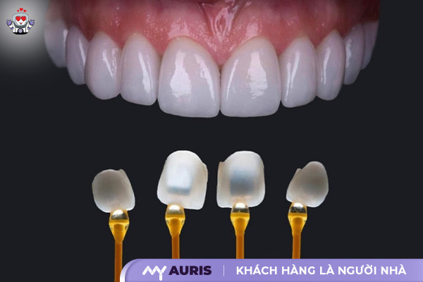 bọc răng sứ emax,răng sứ e max,răng sứ emax,răng sứ emax press,răng sứ thủy tinh,sứ emax press