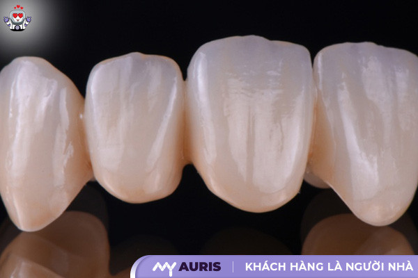 bọc răng sứ emax,răng sứ e max,răng sứ emax,răng sứ emax press,răng sứ thủy tinh,sứ emax press