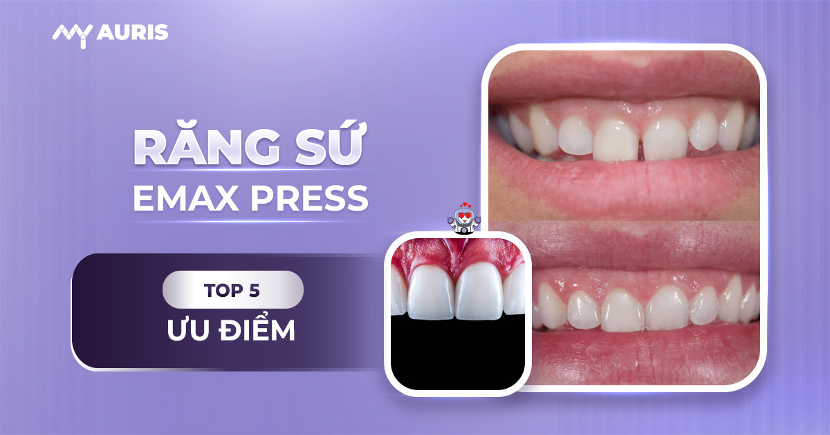 bọc răng sứ emax,răng sứ e max,răng sứ emax,răng sứ emax press,răng sứ thủy tinh,sứ emax press