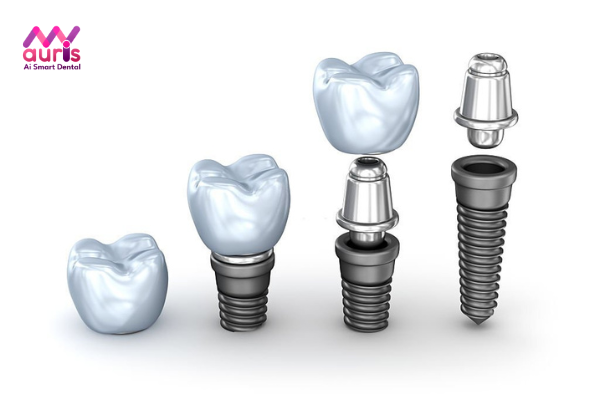 Trồng răng Implant Hải Phòng tại nha khoa My Auris