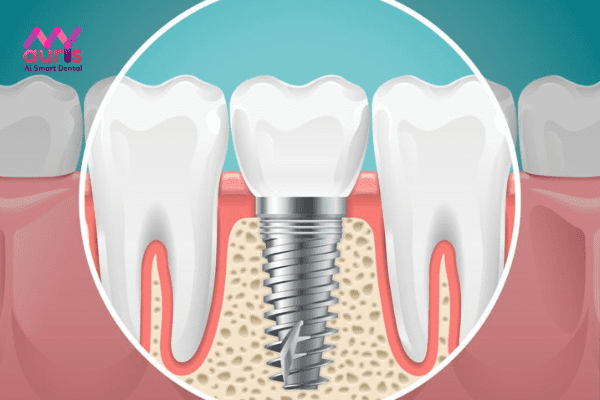Kỹ thuật trồng răng implant là gì?