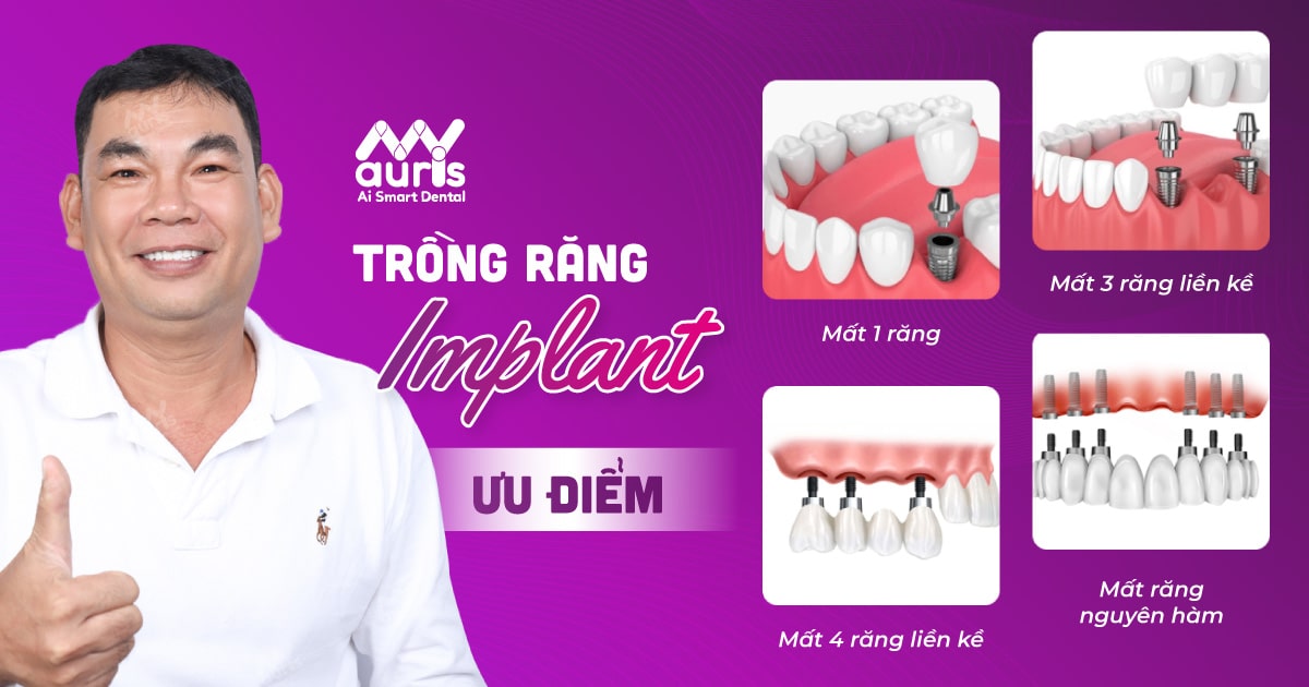 Đối tượng nào trồng răng implant thích hợp nhất