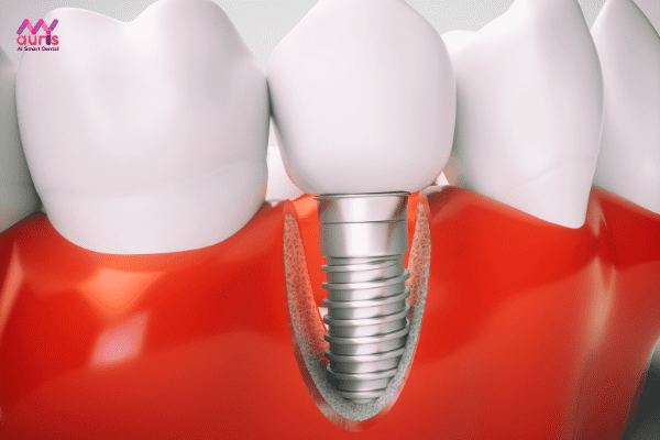Trụ implant Dentium Hàn Quốc có tốt không? 