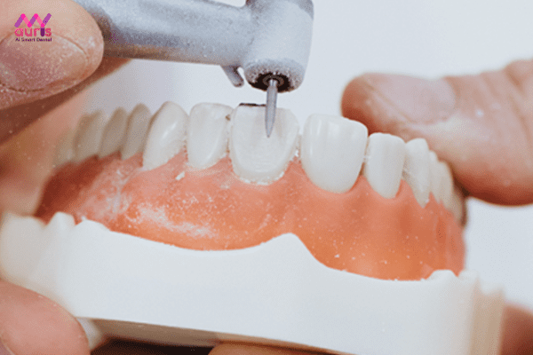 Quy trình mài răng 