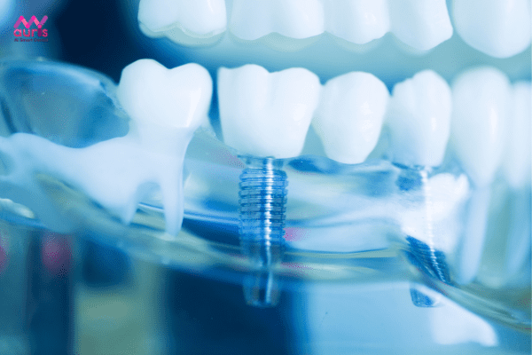 Bệnh nhân mất răng lâu năm có trồng implant được không? 