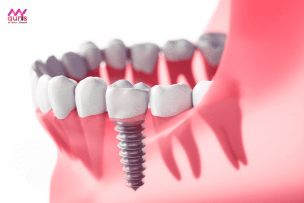 Cấy ghép implant khi mất răng số 5 