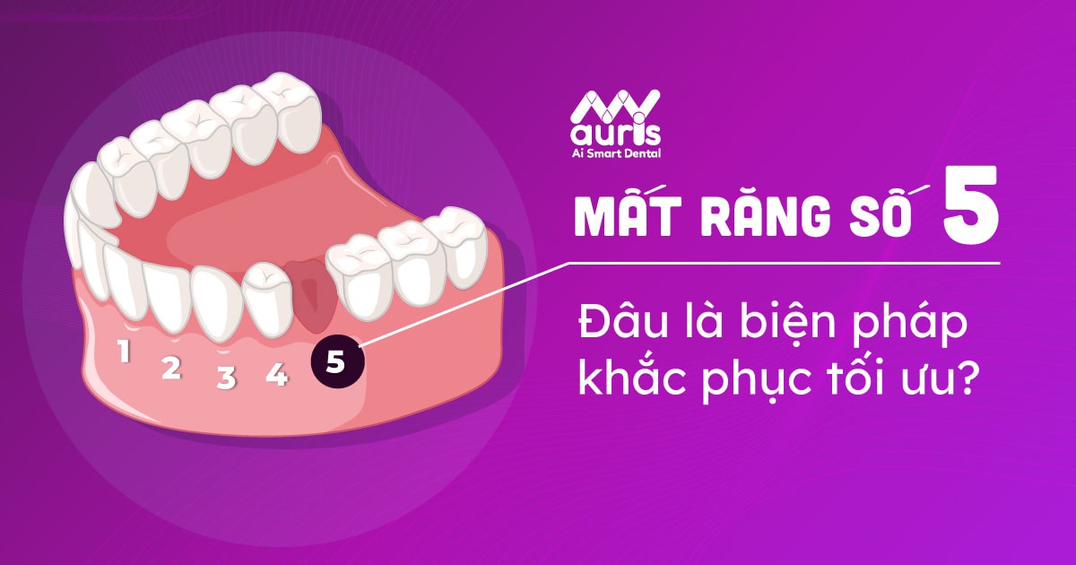 mất răng số 5