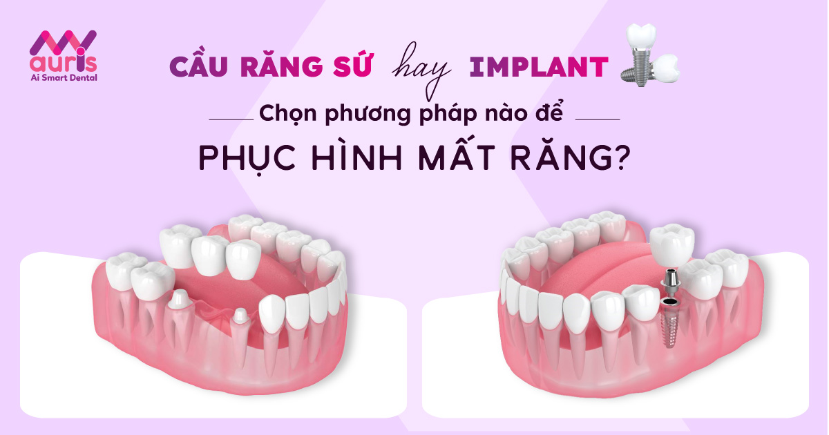 nen-lam-cau-rang-su-hay-implant.jpg