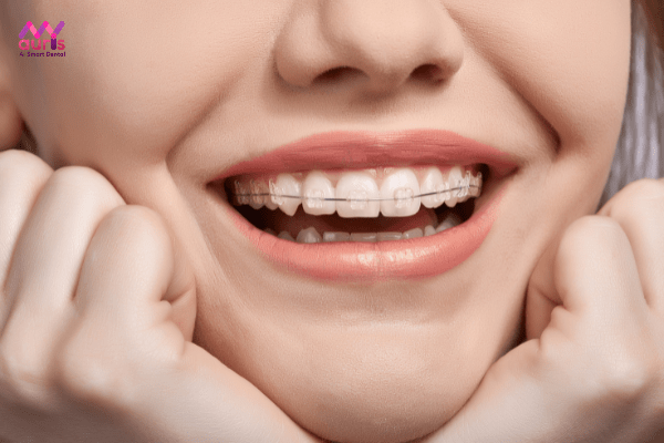 Niềng răng đem đến lợi ích gì? 