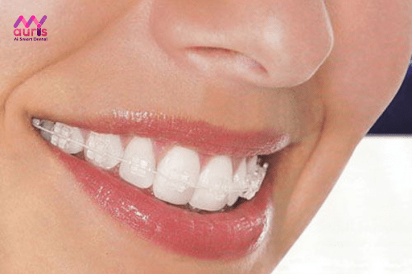 Niềng răng mắc cài sứ dây trong bao lâu? 
