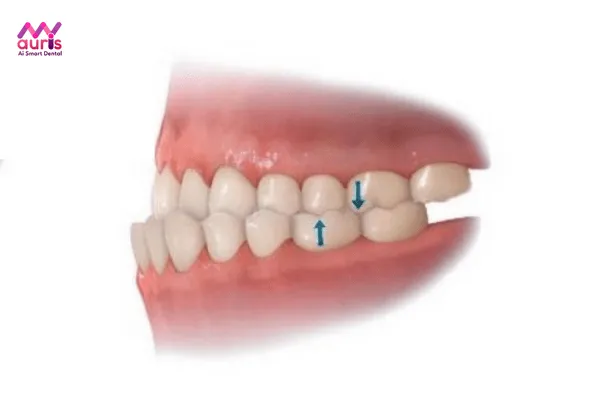 Răng móm và nguyên nhân gây móm 