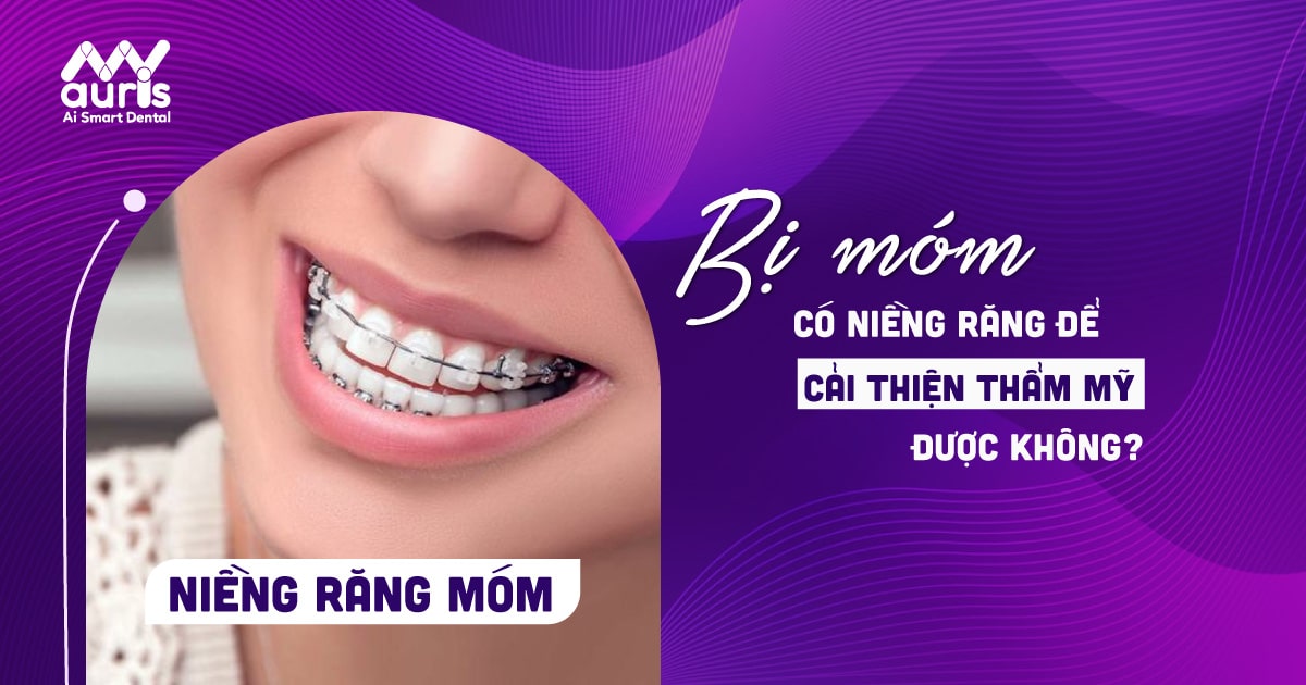 Niềng răng móm bao nhiêu tiền