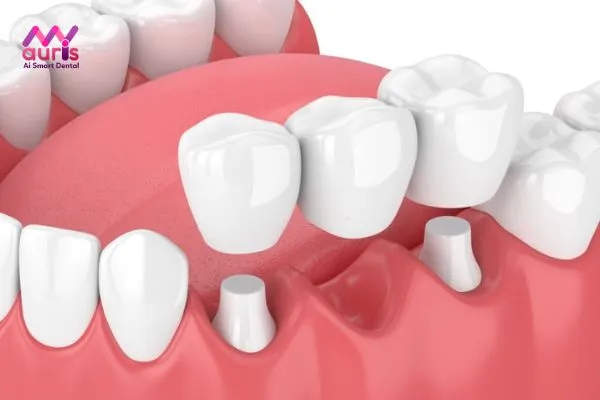Trồng răng sứ là gì?
