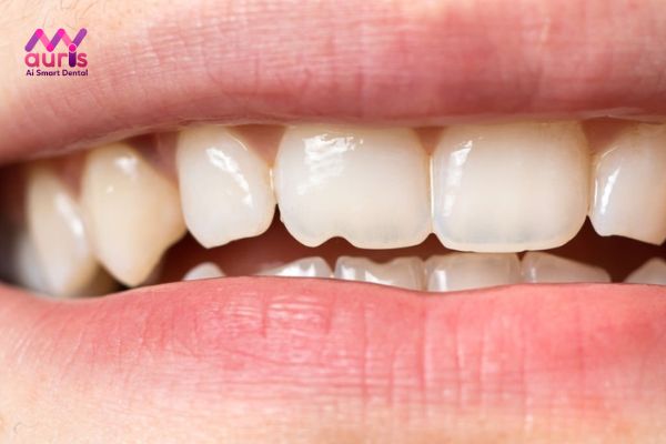 Nguyên nhân gây ra tình trạng mẻ răng?