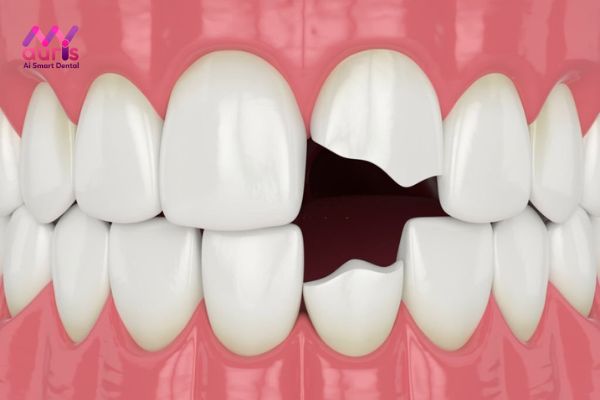 Những nguy cơ khi bị mẻ răng
