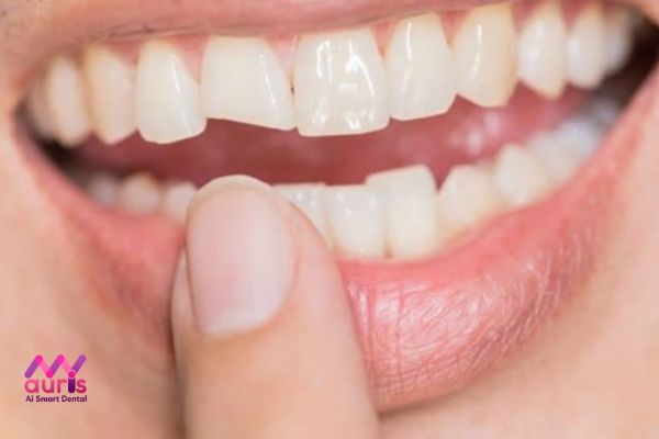 Cách xử lý khi bị mẻ răng