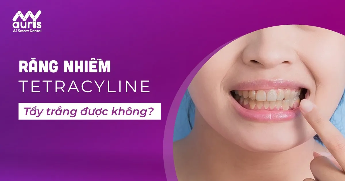 Răng nhiễm Tetracycline có tẩy trắng được không? Cách chữa răng nhiễm Tetracycline hiệu quả nhất?