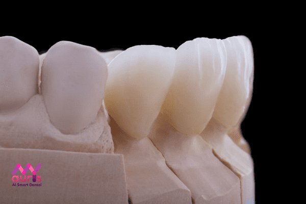 Răng sứ Emax Press là gì?