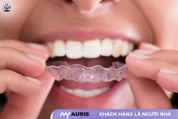 sau khi tháo niềng răng nên làm gì