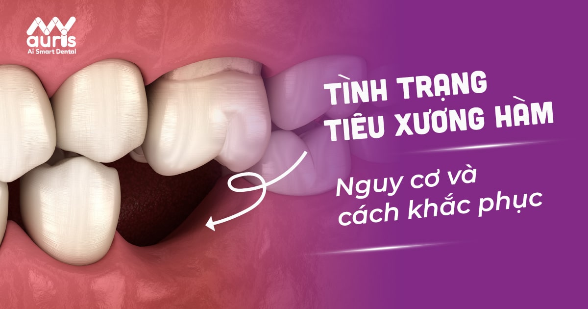 Mất răng bao lâu thì bị tiêu xương hàm?