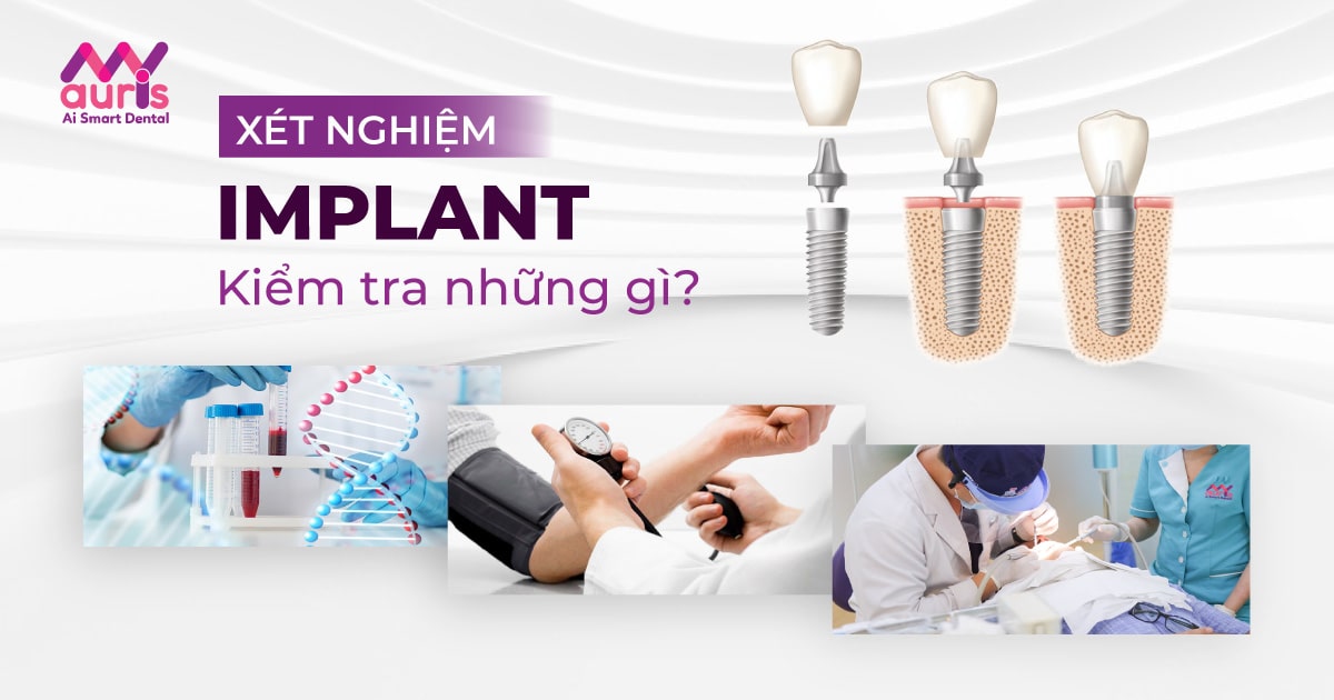 4 xét nghiệm quan trọng bắt buộc phải biết, trước khi trồng răng Implant là gì?