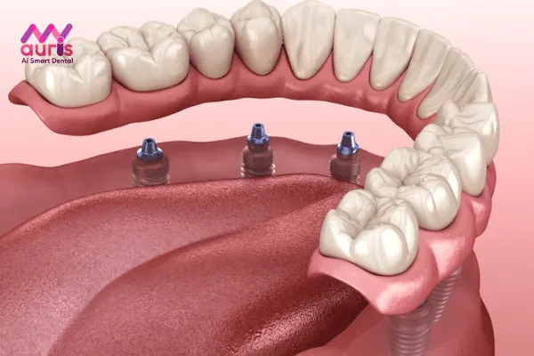 Phương pháp trồng răng Implant All-on-6
