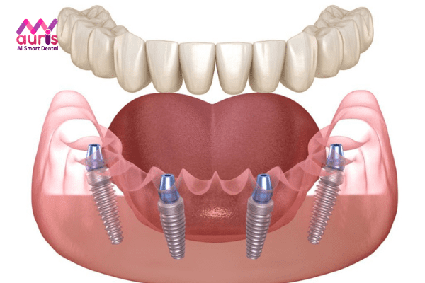 Phương pháp trồng răng Implant All-on-4