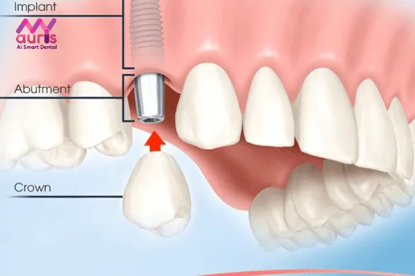 Trồng răng hàm Implant