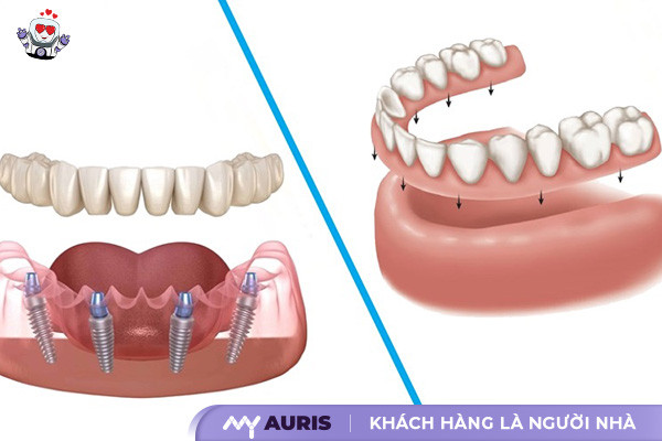 trồng răng implant đà nẵng,trồng răng implant tại đà nẵng