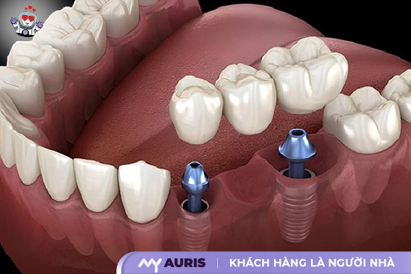 trồng răng implant đà nẵng, trồng răng implant tại đà nẵng