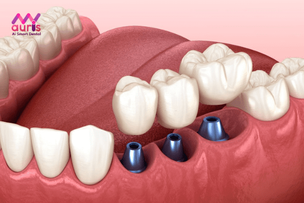 Trồng răng Implant Đà Nẵng đạt chuẩn