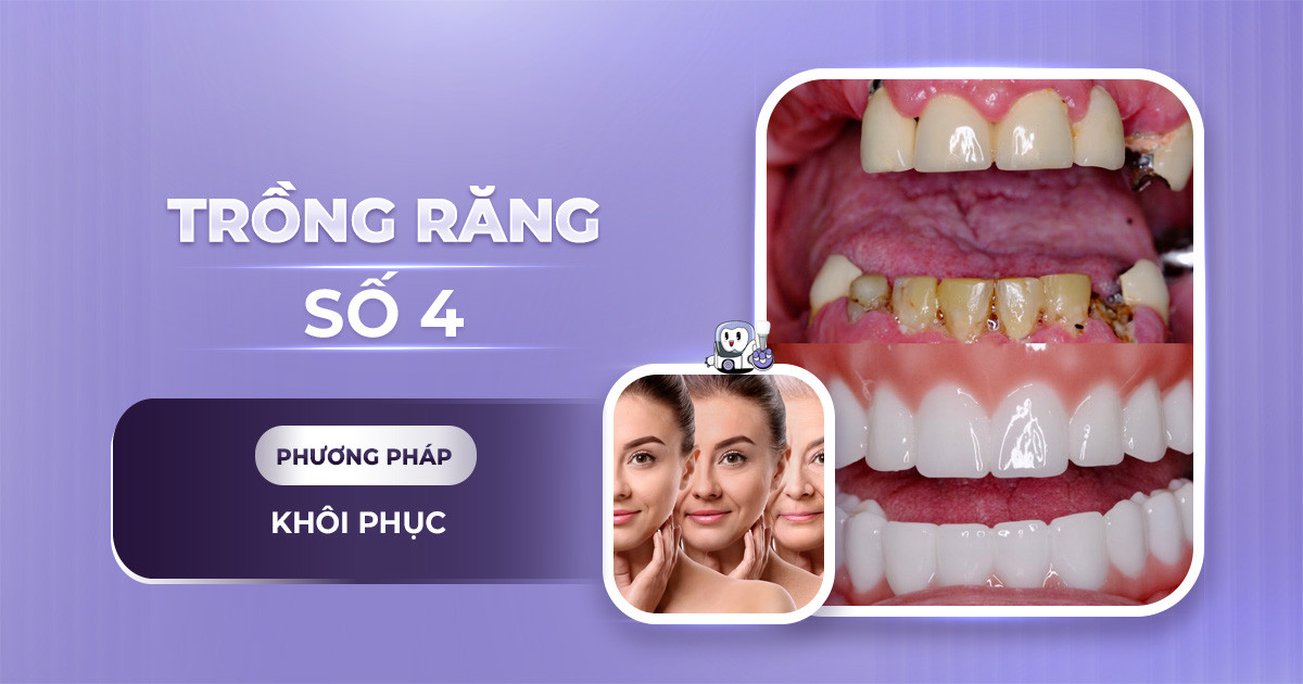 trồng răng số 4