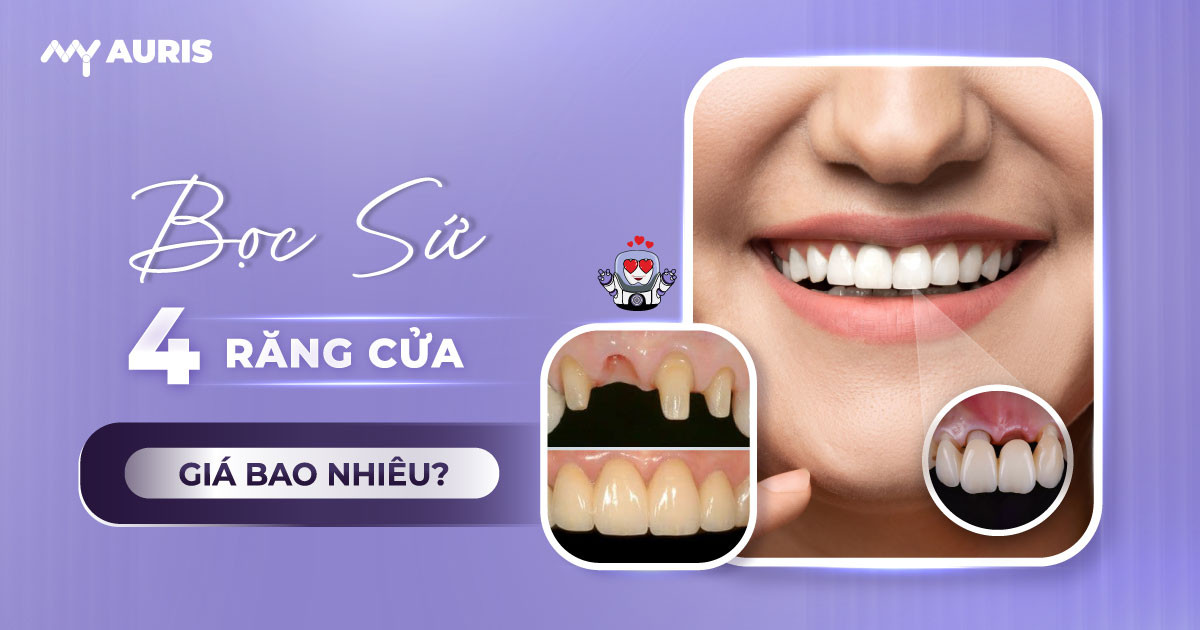 bọc sứ 4 răng cửa giá bao nhiêu