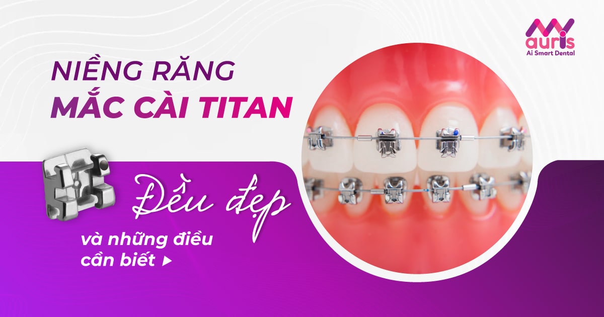 Chi phí niềng răng mắc cài titan