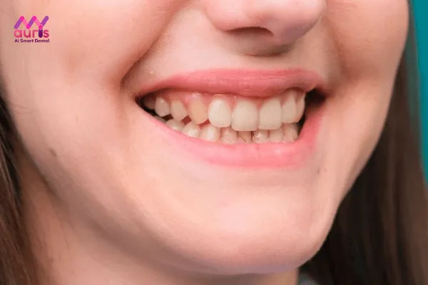 Răng ố vàng tẩy trắng được không? 