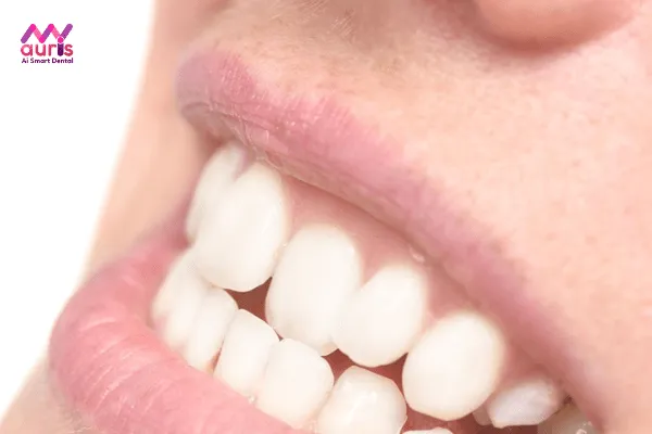 Răng khấp khểnh có dán sứ được không? 
