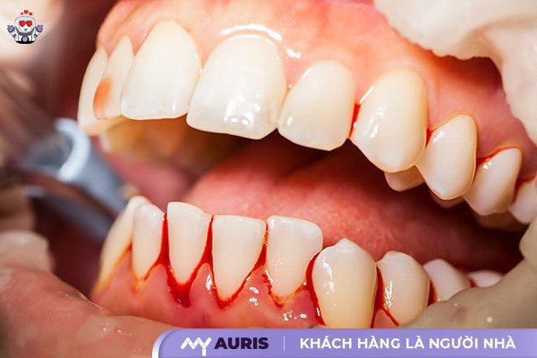 làm răng sứ bị chảy máu chân răng