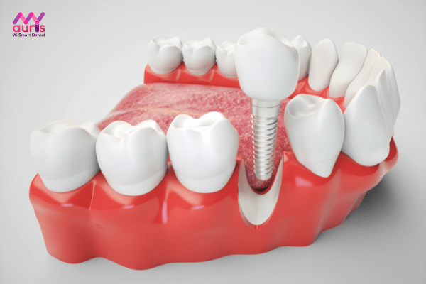 Trồng răng implant cấy khắc phục tình trạng răng mất lâu ngày 