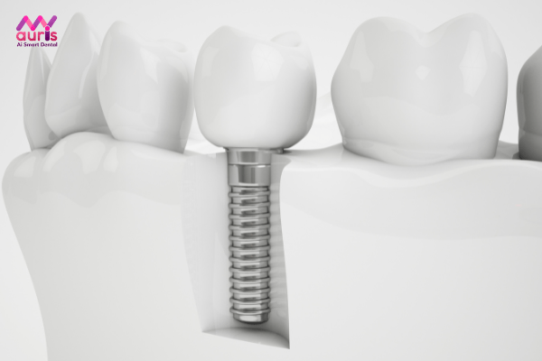 Nên trồng răng implant hay bắc cầu răng sứ 
