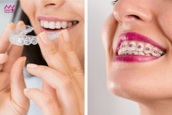 Niềng răng invisalign có đau hơn niềng răng mắc cài? 