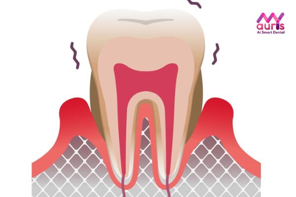 Biến chứng nguy hiểm làm răng sứ sai cách