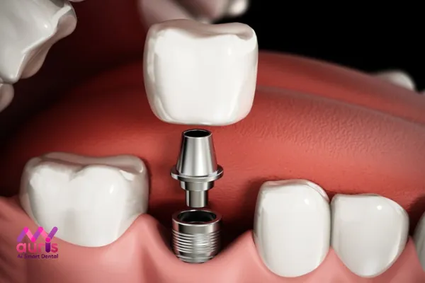 Quy trình trồng răng implant all on 4