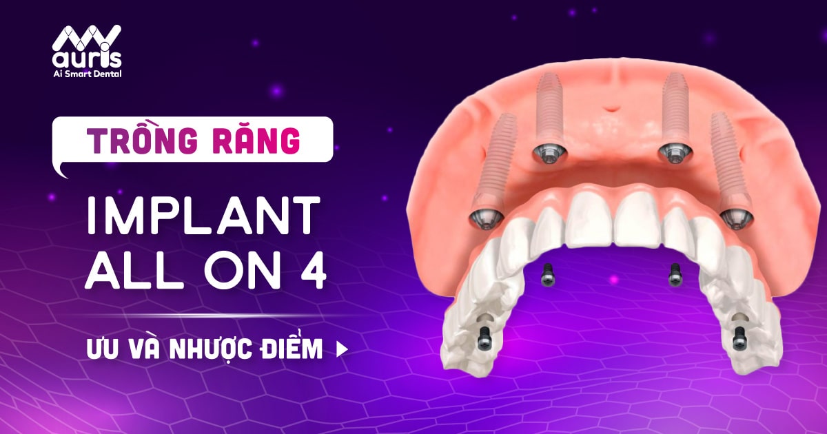 TRỒNG RĂNG IMPLANTS Trồng răng implant all on 4 – giải pháp mới cho người mất răng toàn hàm