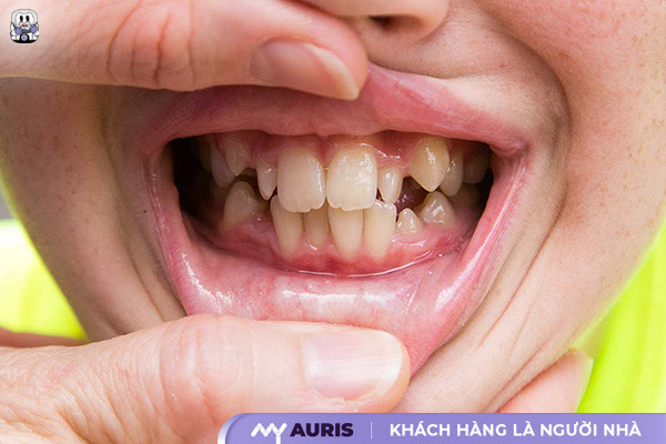 cách làm răng đều không cần niềng tại nhà