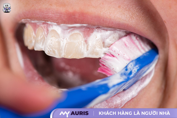 cách làm răng đều không cần niềng tại nhà