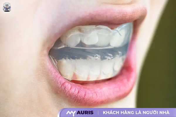 cách làm răng đều không cần niềng tại nhà